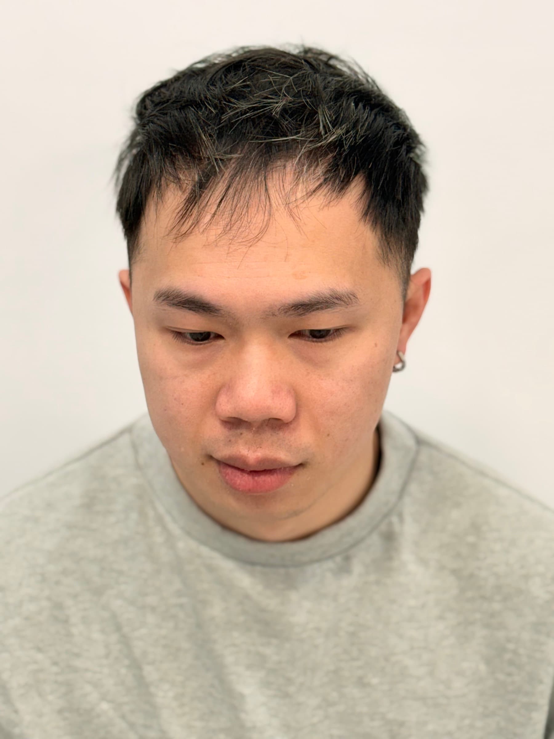 Front hairline before fitting showing recession.