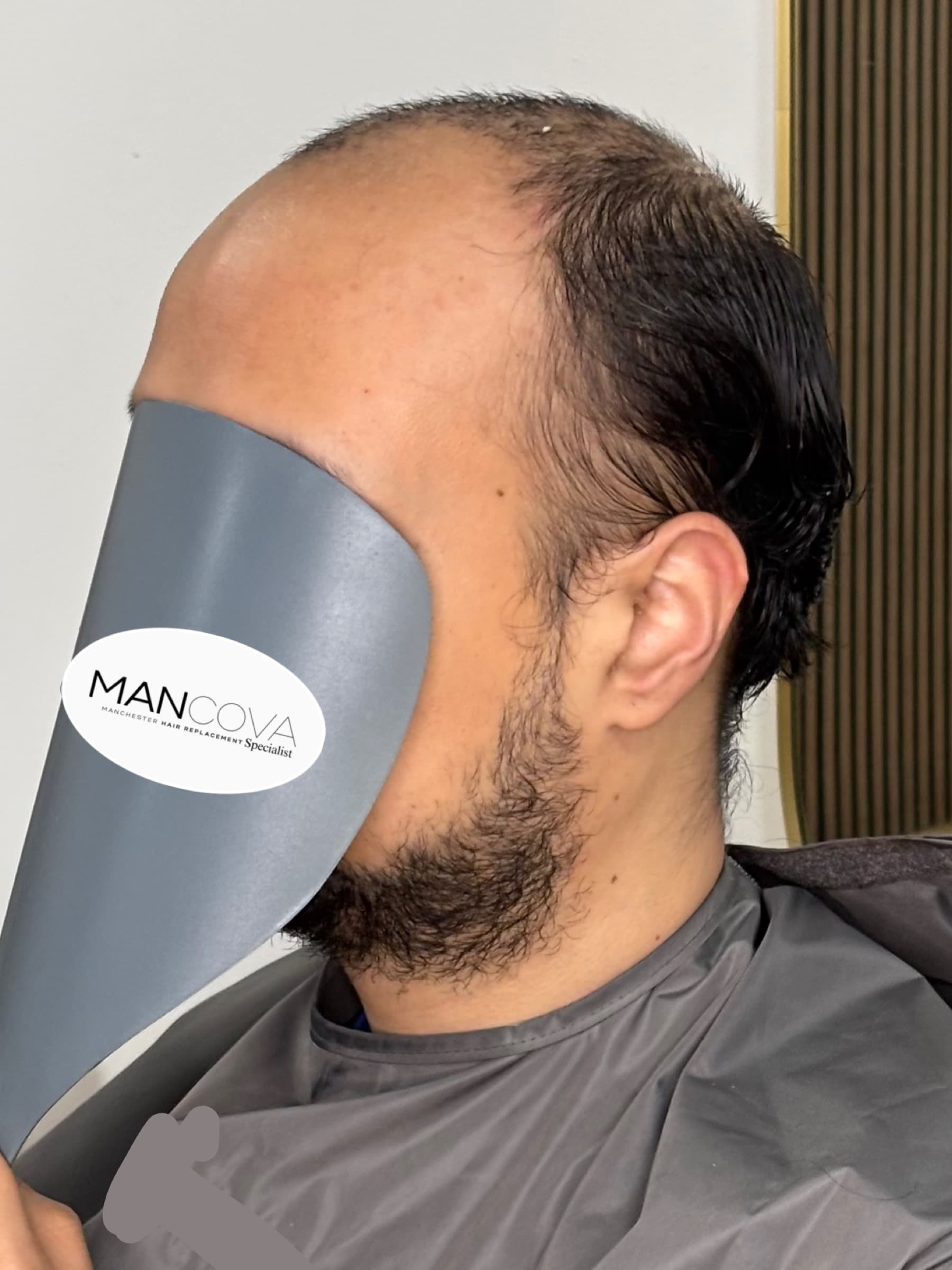 Side angle before fitting showing the starting hairline.